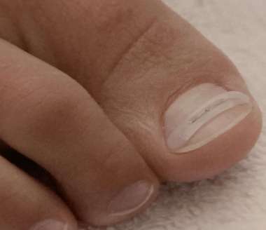 Spangentechnik, Zehnagel mit Spange